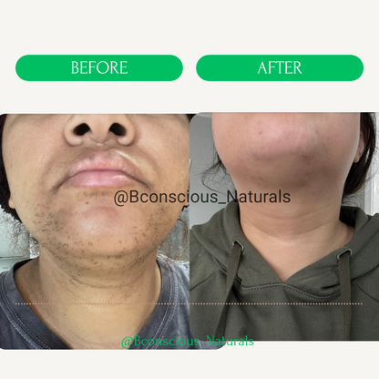 Pcos/Hirsutism Vegan Natural Face/Body Hair Removal Oil(Inhibits Chin Hair & Slows Down Hair Growth)