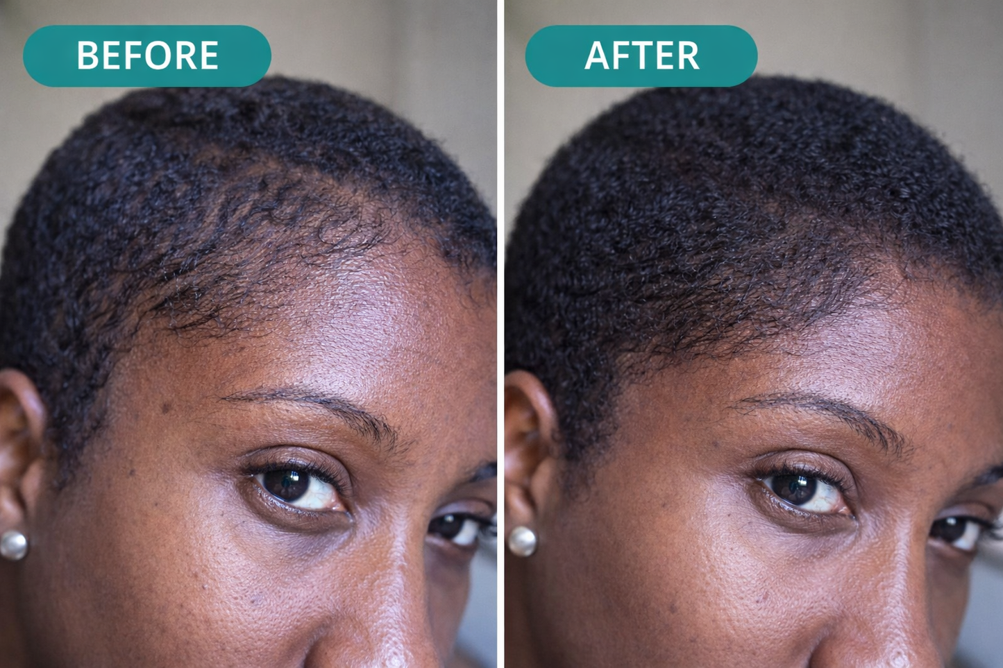 PCOS Hair Growth Oil for Women | Natural Scalp Support