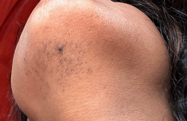 Before - Melissa, 30