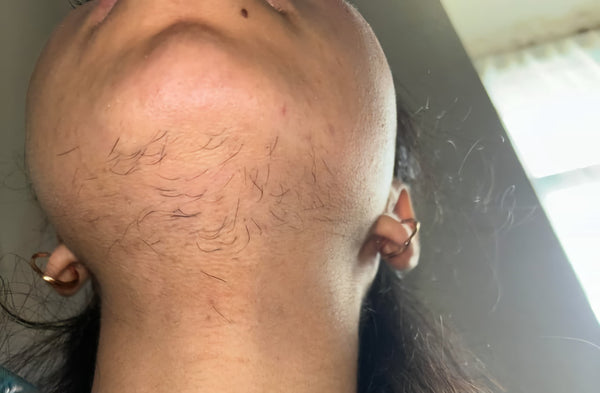 Before - Aisha, 26