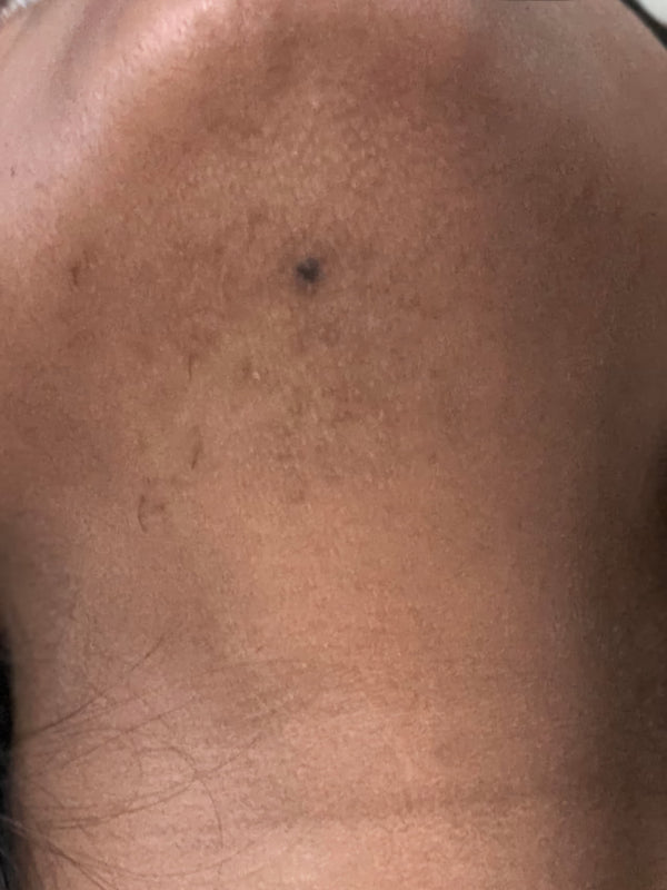 After - Melissa, 30