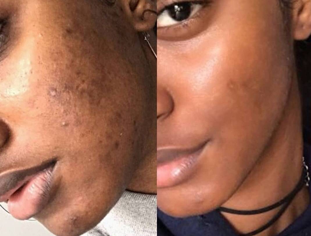 Bconscious Naturals™ 100% Vegan & Natural Plant-Based Skin Brightening Kojic Acid Body Lotion
Even Skin Tone, Clear Dark Marks, & Naturally Toning with Kojic Acid