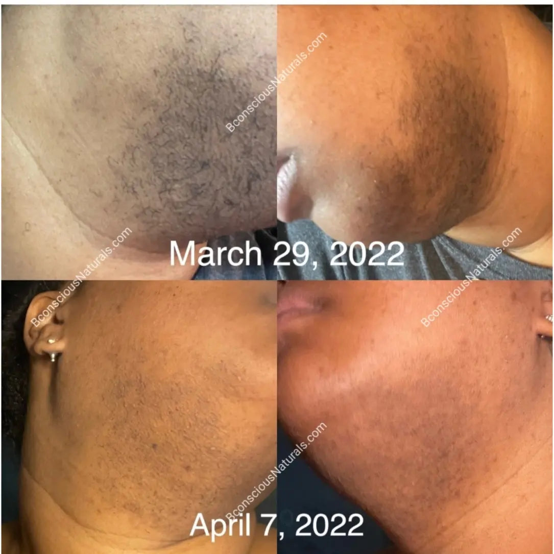 Chin online hair removal